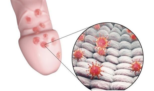 alergie na gel na zvětšení penisu