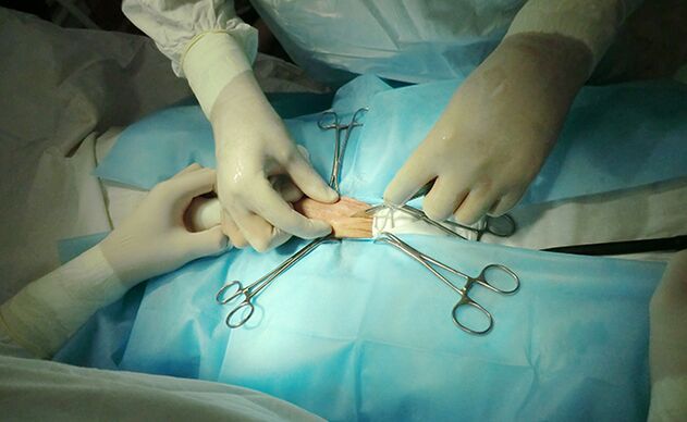 Operace na reprodukčním orgánu pomůže zvýšit jeho velikost